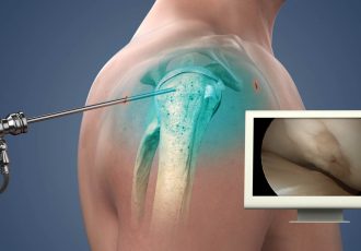 Shoulder Arthroscopic