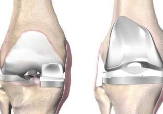 Partial Unicondylar Patello-Femoral