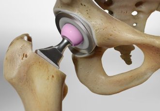 Total-Hip-Replacement