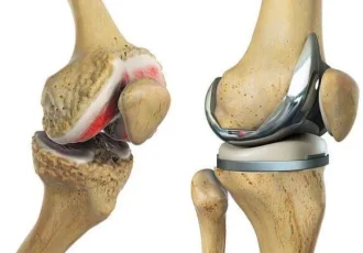 Total Knee Replacement