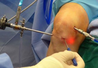 Knee Arthroscopic